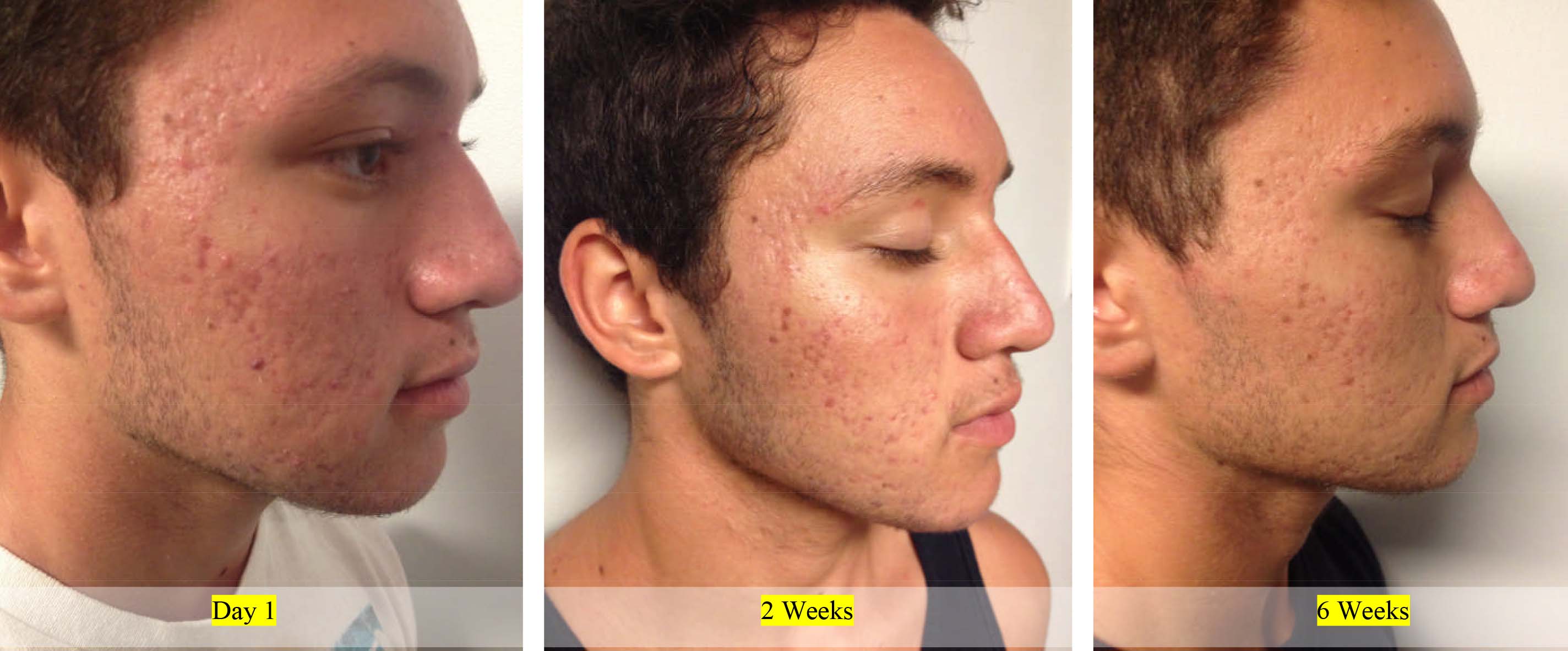 Acne Control Before and After