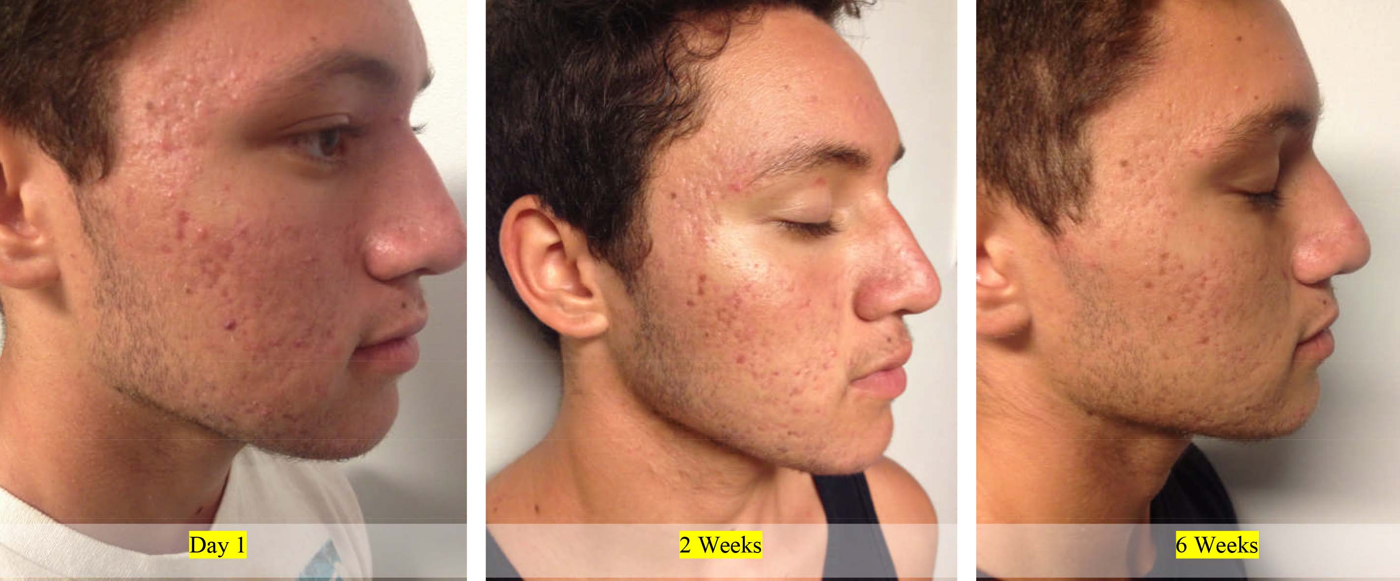 Acne Control Before and After 