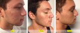 Acne Control Before and After 
